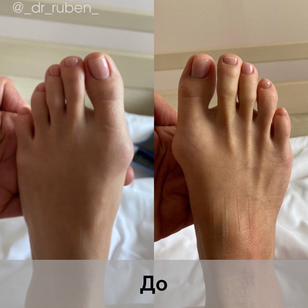 Болит косточка на большом пальце ноги: причины и лечение