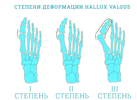 Вальгусная деформация большого пальца ноги