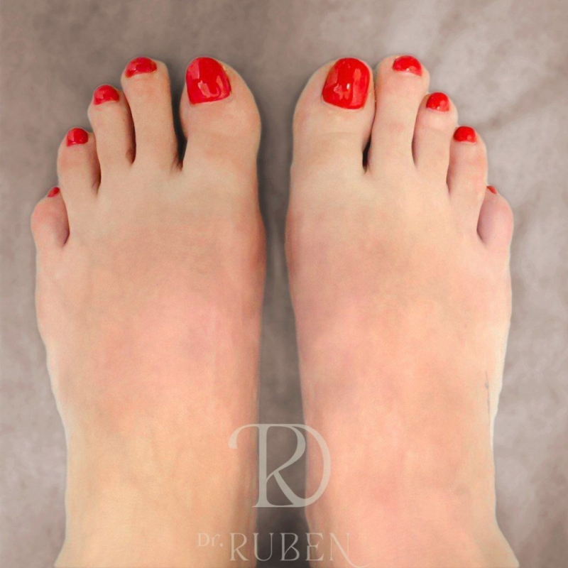 Hallux Valgus операция: результат