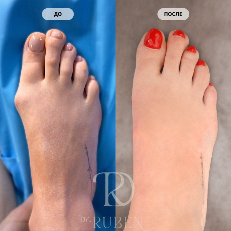 Hallux Valgus операция: до и после