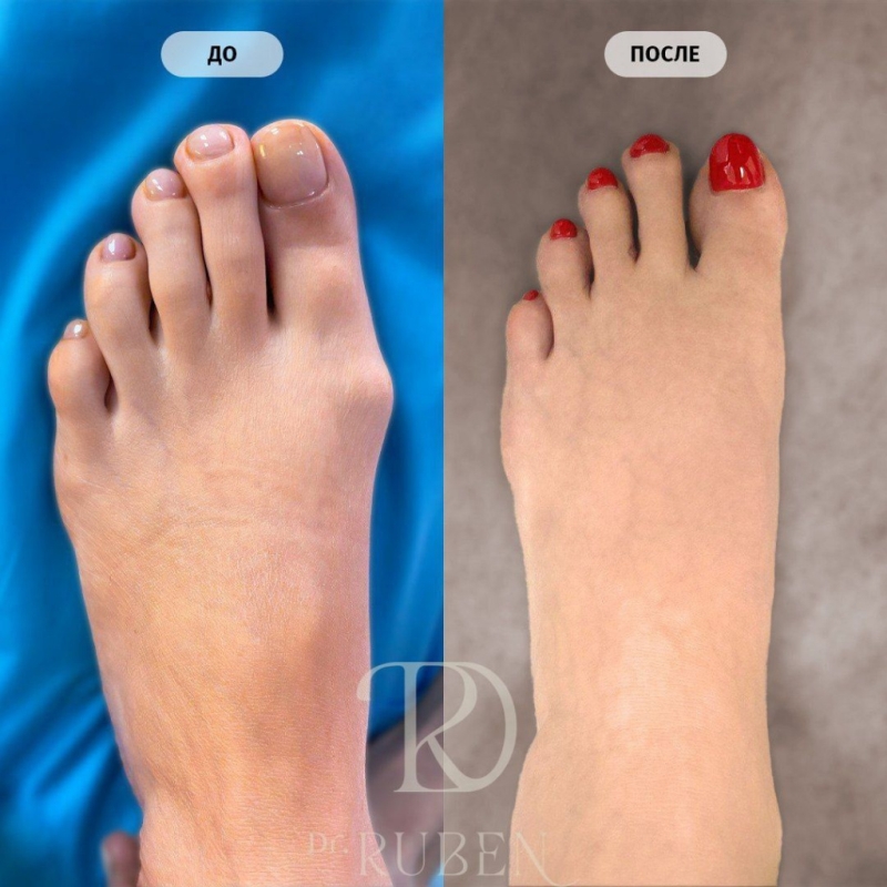 Hallux Valgus операция: до и после
