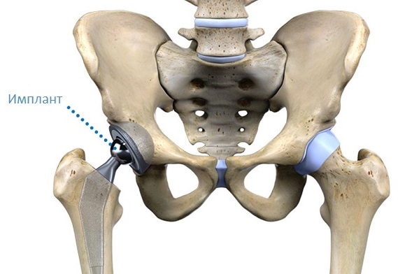 Эндопротезирование коленного сустава - цена операции и реабилитация в клинике СОЮЗ