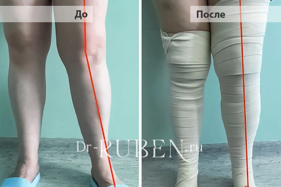 Вальгусная деформация коленного сустава, вторичный левосторонний гонартроз 3 степени, ревматоидный полиартрит