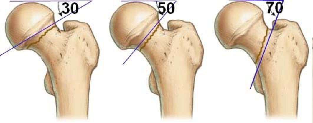Повреждение бедренной кости. Вколоченный перелом шейки бедра рентген. Вколоченный перелом шейки бедра. Перелом шейки бедра классификация субкапитальный. Базисцервикальный перелом шейки бедра.