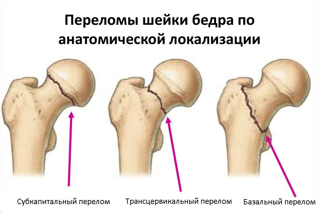 ᐈ Перелом шейки бедра: симптомы и лечение ~【Киев】