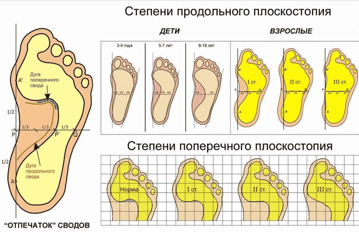 Что такое плоско-вальгусная установка стоп?